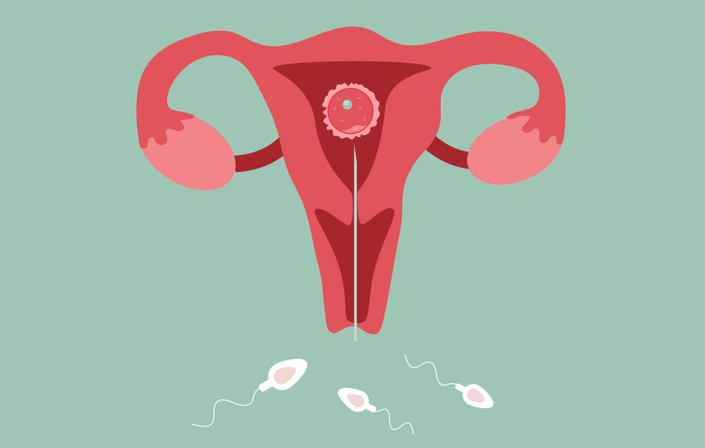 What is IUI and how is it done?